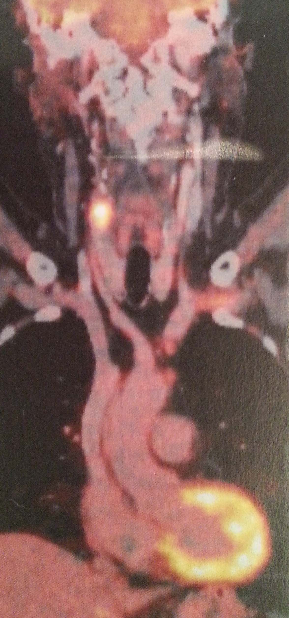 209 PET CT  20140329 091329