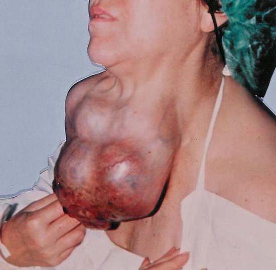210d grosse Struma bösartig Mandl gescanntes Photo besser
