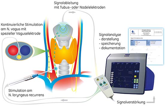 313d Schilddrüsenmodell kont Vagusstimulation